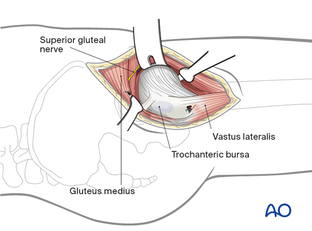 Exposure of the hip capsule in the anterolateral approach (Watson-Jones) to the proximal femur