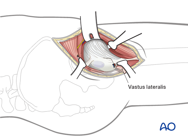 Anterior release of vastus lateralis in the anterolateral approach (Watson-Jones) to the proximal femur