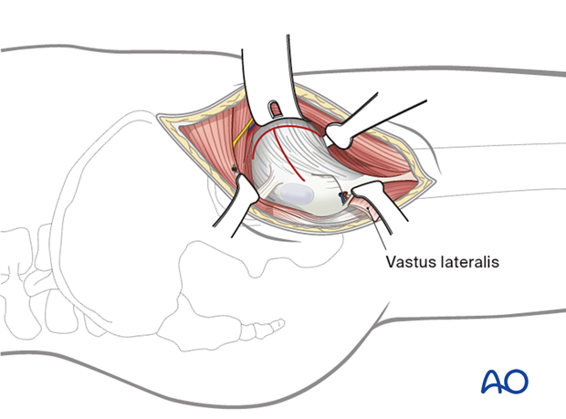 Opening the hip joint capsule in the anterolateral approach (Watson-Jones) to the proximal femur