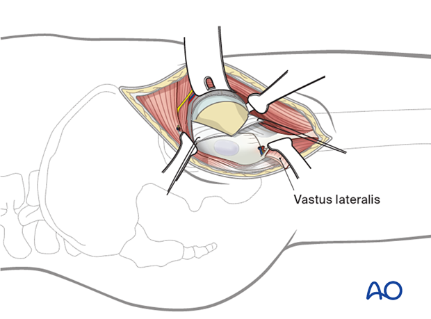 For direct access to a femoral neck fracture, the lateral incision can be extended proximally and anteriorly.