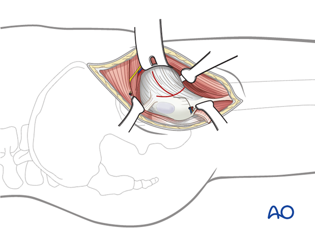 Opening the hip joint capsule in the anterolateral approach (Watson-Jones) to the proximal femur