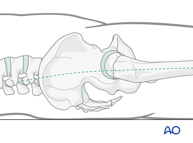 The incision for insertion of a proximal femoral nail must lie along the curved axis (dashed line) of the femoral canal.