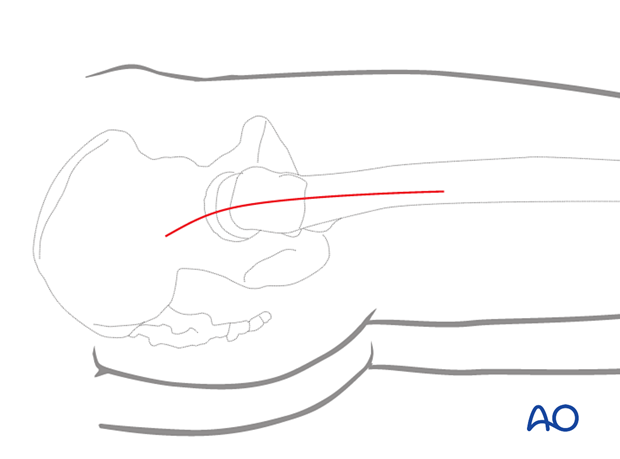 Longitudinal incision for a direct lateral approach to the proximal femur, through the skin and subcutaneous tissue, with its proximal end directed slightly posteriorly