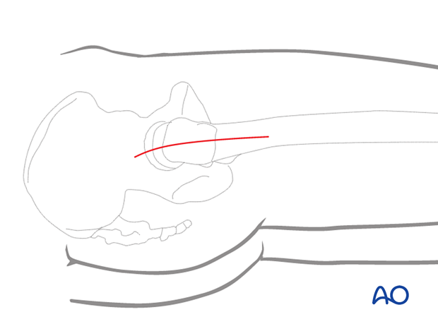 Lateral approach to the proximal femur with a limited longitudinal incision