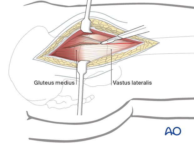 Division of the fascia lata over the greater trochanter in the direct lateral approach