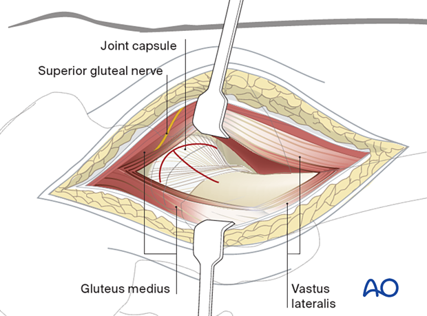 Deep dissection of the direct lateral approach to the proximal femur through the gluteus medius and minimus proximally, retracting the anterior flap to show the hip capsule superiorly and adjacent supraacetabular ilium