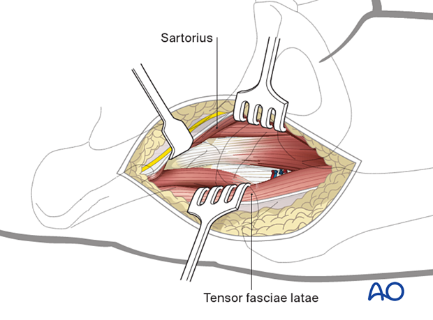 Blunt dissection of the sartorius interval medially to retract the tensor fasciae latae laterally during the anterior approach (Smith-Petersen) to the proximal femur
