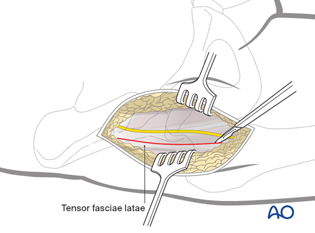 Incision of the fascia over the tensor fasciae latae during the anterior approach (Smith-Petersen) to the proximal femur
