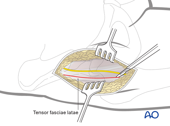 Anterior approach (Smith-Petersen) to the proximal femur