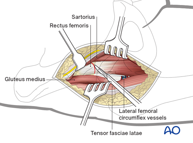 Release of the direct head of the rectus femoris from the anterior inferior iliac spine during the anterior approach (Smith-Petersen) to the proximal femur
