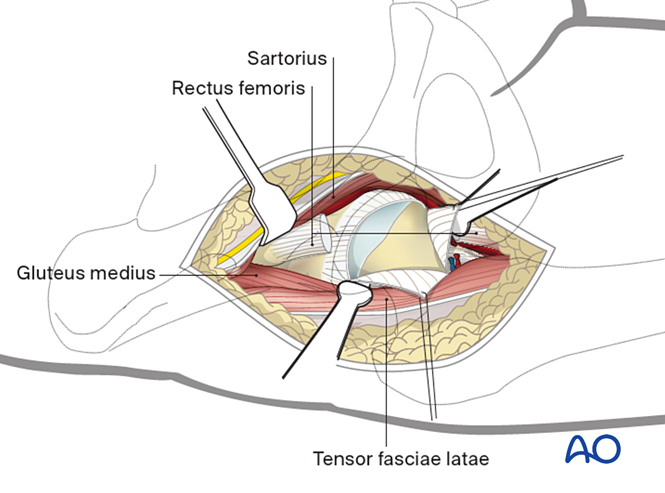 Anterior approach (Smith-Petersen) to the proximal femur