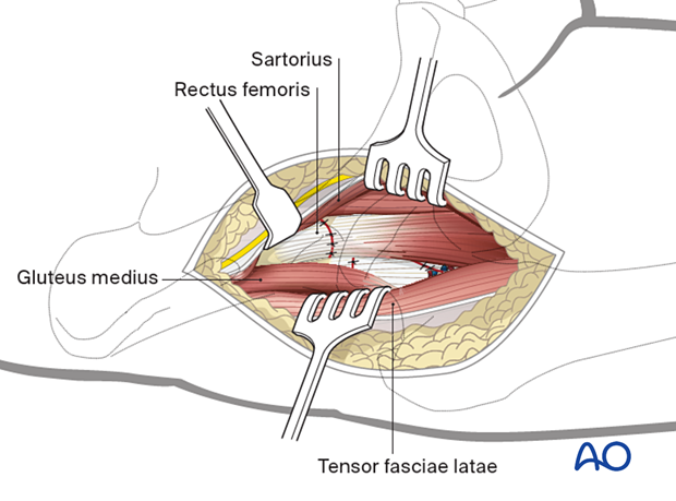 Wound closure of the anterior approach (Smith-Petersen) to the proximal femur with reattached rectus femoris