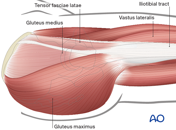 Tensor fasciae latae, gluteus medius, gluteus maximus, vastus lateralis, and iliotibial tract