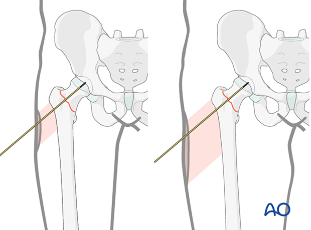 Location and size of the lateral incision for implant insertion in the proximal femur depending on soft-tissue thickness