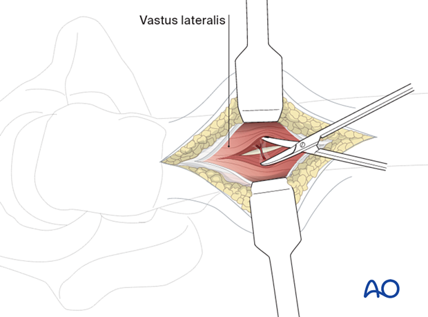 Blunt exposure and incision through the fascia of the vastus lateralis during a limited lateral approach for implant insertion in the proximal femur
