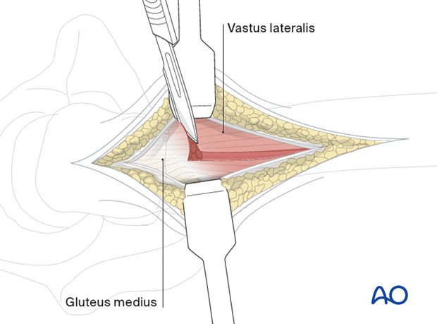 Anterior reflection of vastus lateralis during a limited lateral approach for implant insertion in the proximal femur