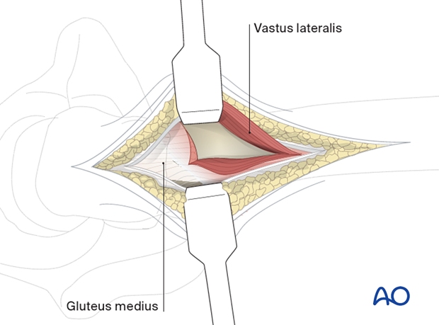 Anterior reflection of vastus lateralis during a limited lateral approach for implant insertion in the proximal femur