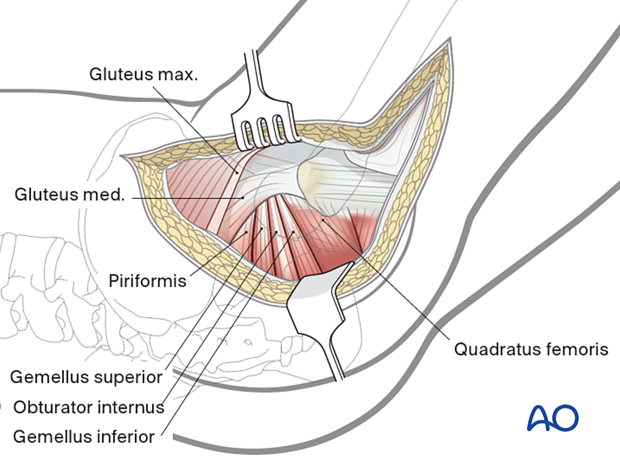 Posterolateral (posterior) approach to the hip with exposure of the short external rotator tendinous insertions