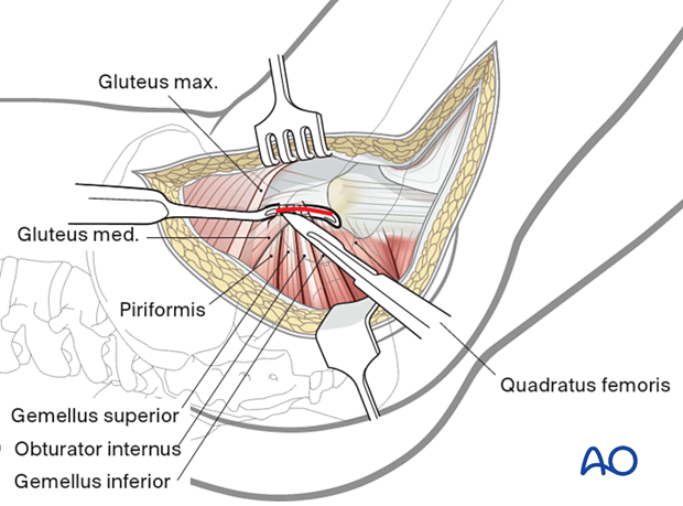 Blunt dissection of the tendinous insertions of the short external rotators and cutting them close to the greater trochanter during the posterolateral (posterior) approach to the hip