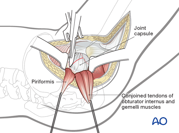 With the short rotator muscles reflected to protect the sciatic nerve and the hip capsule exposed, the joint is entered with a capsulotomy parallel to the femoral neck