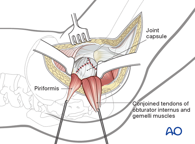 Closure of the capsulotomy of the posterolateral (posterior) approach to the hip