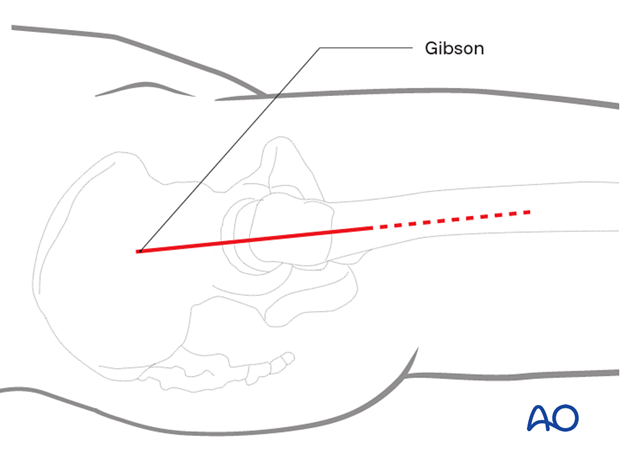Skin incision for a trochanteric flip osteotomy through the Gibson interval