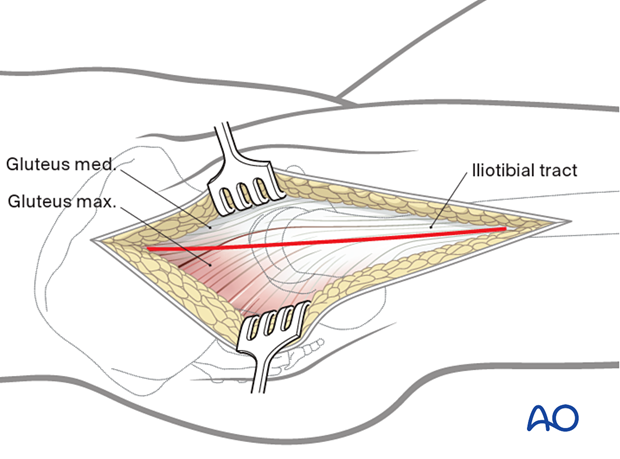 Gibson interval between the gluteus maximus and medius for a trochanteric flip osteotomy