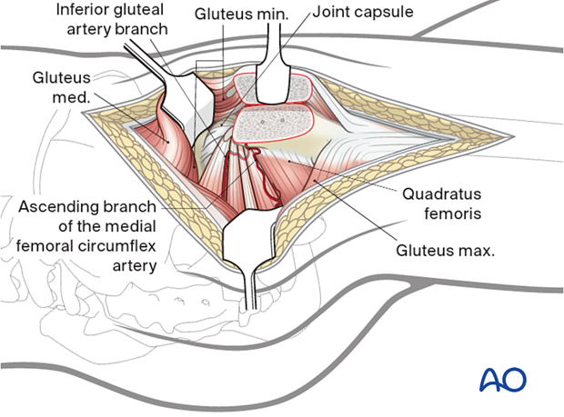 Anterior exposure and mobilization of gluteus minimus after trochanteric osteotomy