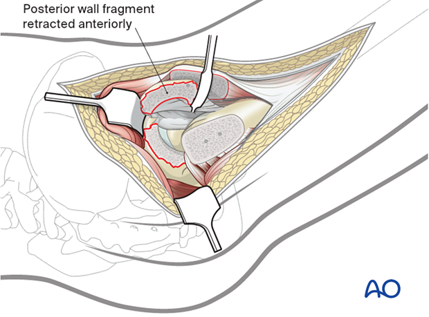 Mobilized and retracted wall fragment(s) after capsulotomy and trochanteric flip osteotomy