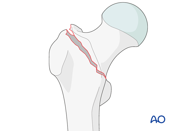 Simple two-part pertrochanteric fracture
