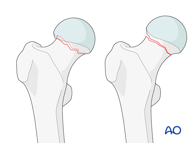 Subcapital femoral neck fractures with valgus impaction or with little or no displacement