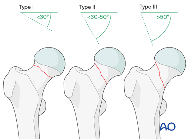 femoral neck fracture