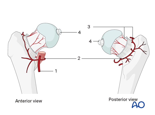 The blood supply of the femoral head with 1. profunda femoris artery, 2. medial femoral circumflex artery, 3. retinacular vessels, and 4. ligamentum teres