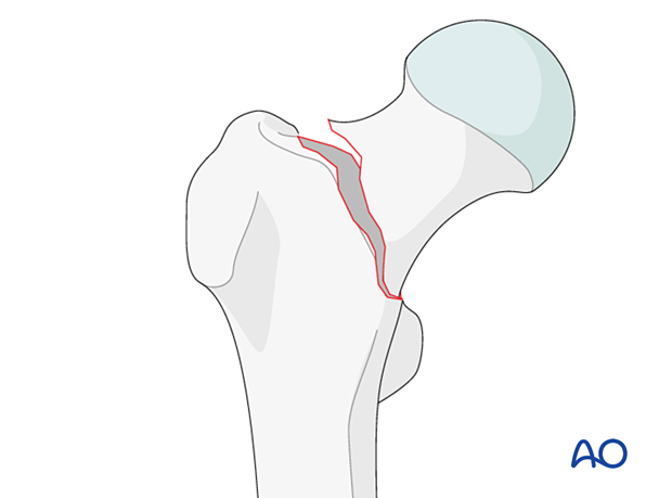 Basicervical femoral neck fracture