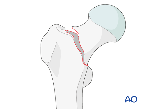 femoral neck fracture