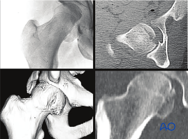 X-ray and CT views of a combined fracture of the femoral head and posterior wall of the acetabulum