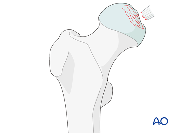 Depression fracture of the femoral head
