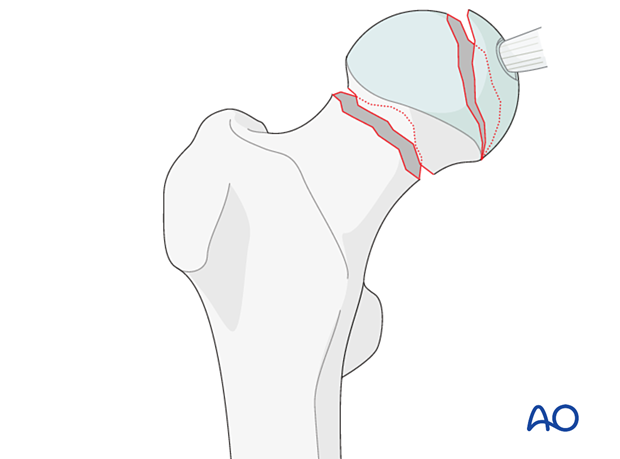Combined fracture of the femoral head and neck