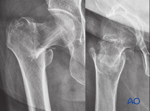 AP and lateral x-rays of a simple pertrochanteric two-part fracture