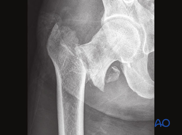 X-ray of a superolateral displacement of the shaft in a simple pertrochanteric fracture with posteromedial involvement and an intact lateral wall