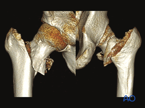 3-D CT view of a superolateral displacement of the shaft in a simple pertrochanteric fracture with posteromedial involvement and an intact lateral wall