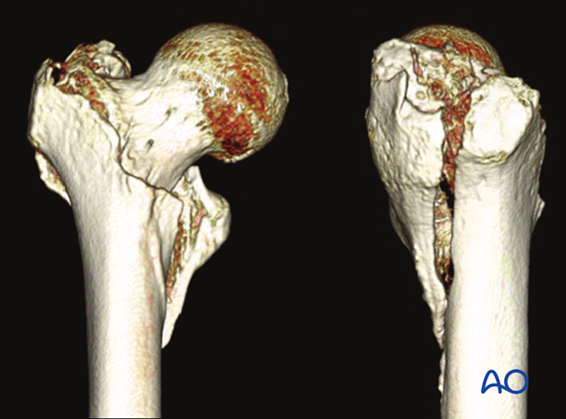 X-ray of a multifragmentary pertrochanteric fracture with an incompetent lateral wall