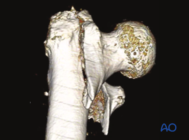 3-D CT view of a multifragmentary pertrochanteric fracture with an incompetent lateral wall