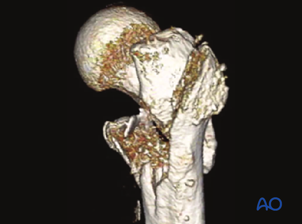 3-D CT view of a multifragmentary pertrochanteric fracture with an incompetent lateral wall