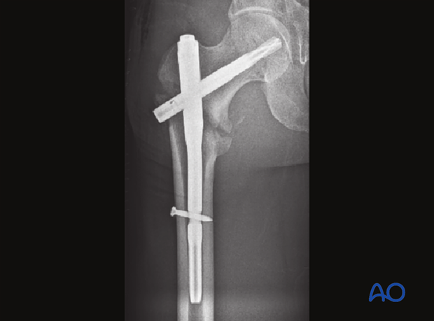 X-ray of an intertochanteric fracture fixed with a short intramedullary nail