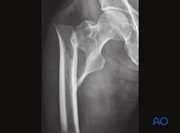 X-ray of a simple oblique intertochanteric fracture