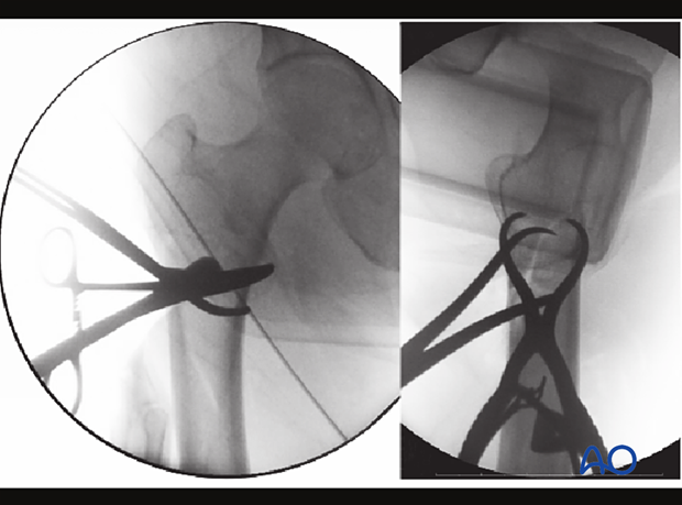 AP and lateral views of reduction of a simple oblique intertochanteric fracture with Weber forceps