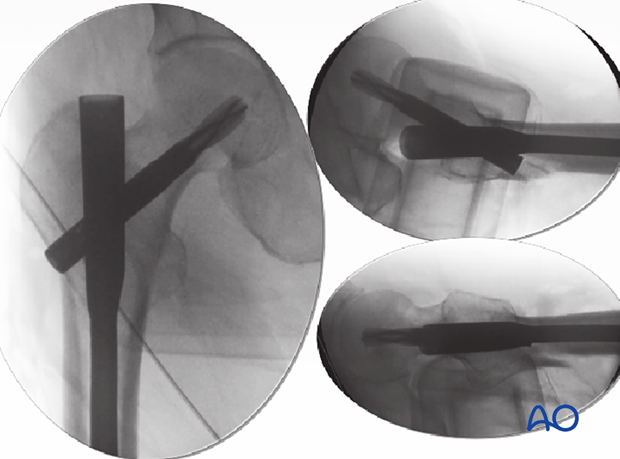 Final intraoperative views of an intertrochanteric fracture fixed with a short intramedullary nail