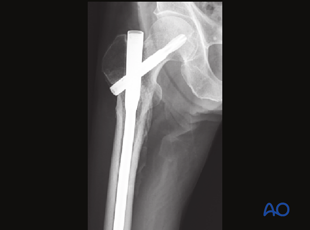 Follow-up x-ray of an intertrochanteric fracture fixed with a short intramedullary nail
