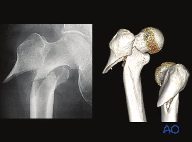 AP x-ray and 3-D CT view of a simple oblique intertrochanteric fracture